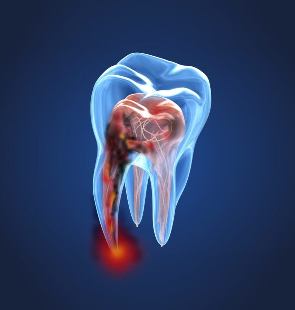 Tooth extraction in mount pleasant