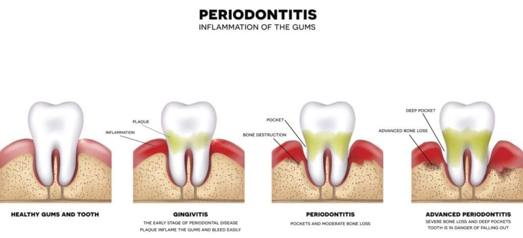 Periodontal treatments for bleeding gums in Mount Pleasant, MI