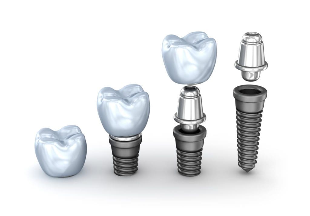 What are Dental Implants Mount Pleasant, MI