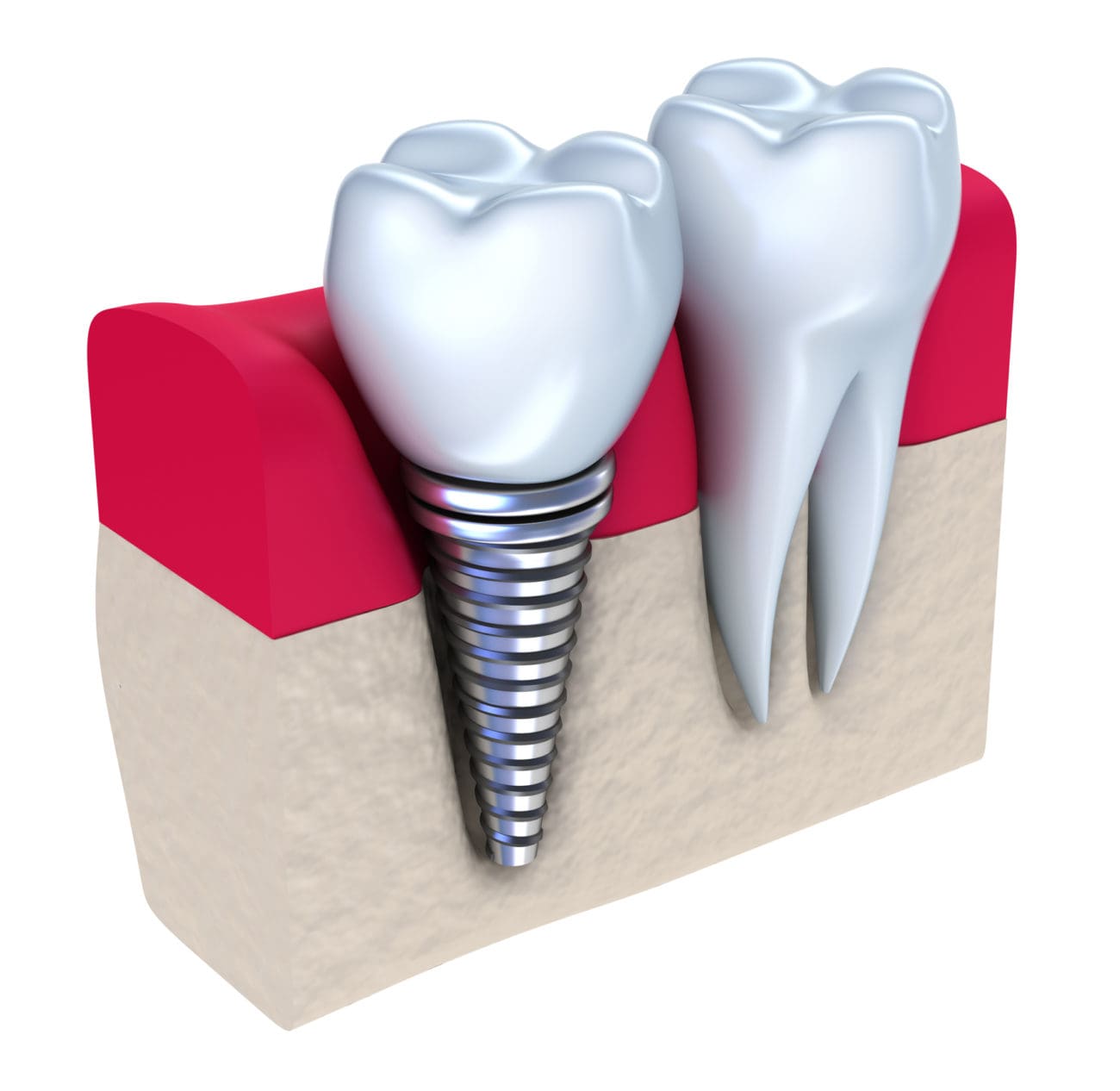 The Cost of Dental Implants in Mount Pleasant, MI