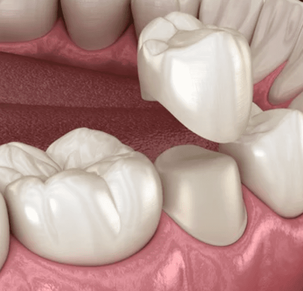The Many Uses of Dental Crowns